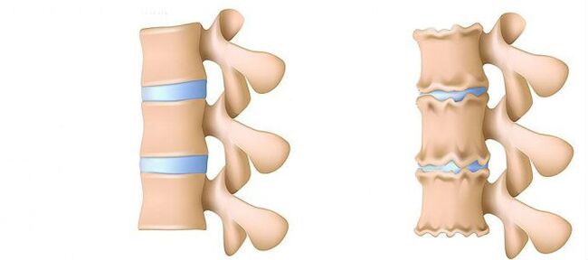 Co je to osteochondrosis