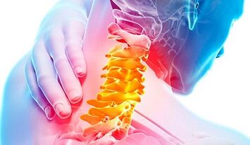 Známky osteochondrosy krční páteře