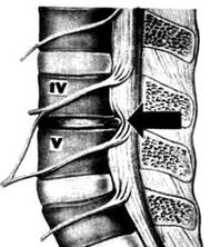 X -ray obrázek bederní oddělení osteochondrosis