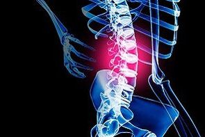 osteochondróza bederní páteře