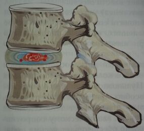 První fáze osteochondrózy