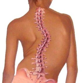 Zakřivení páteře vede k osteochondróze