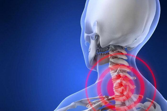 Vystřelující bolest v krku je časným příznakem cervikální osteochondrózy